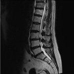 ein Röntgenbild einer Wirbelsäule mit Spinalkanalstenose
