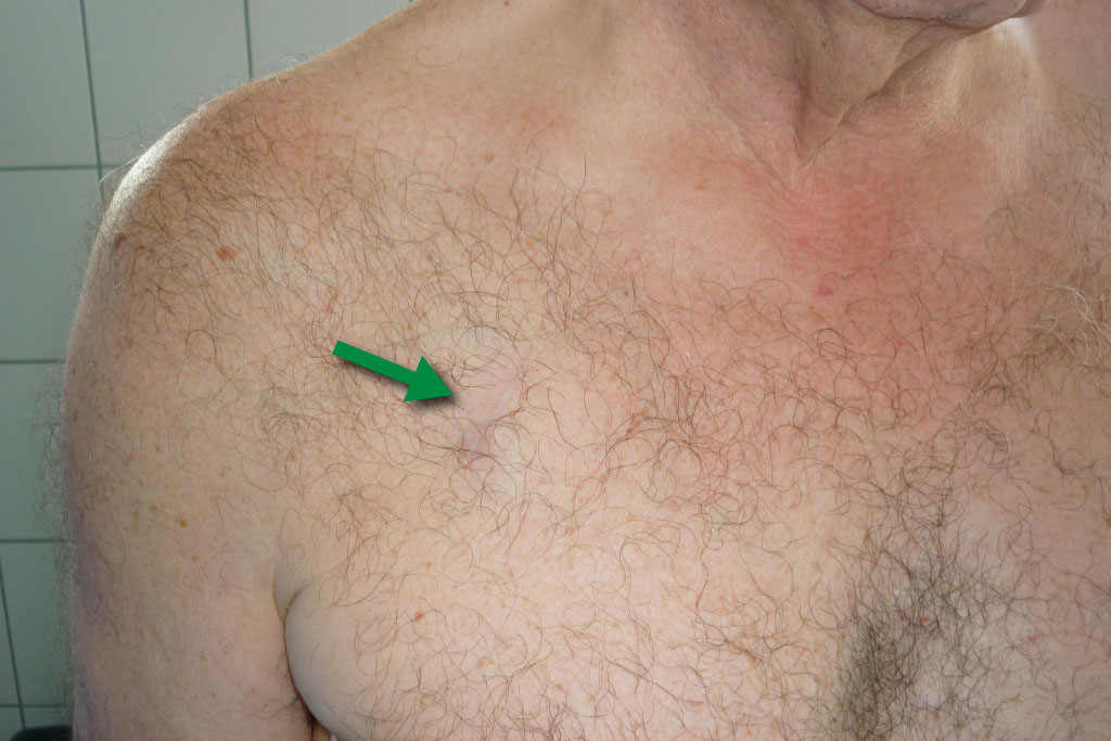 der Brustbereich eines Mannes mit eingeheilter Portkammer